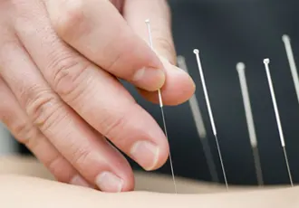 Acupuncture